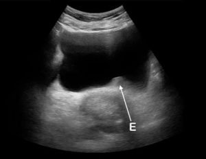 ultrasound υπερηχος ουροποιητικου